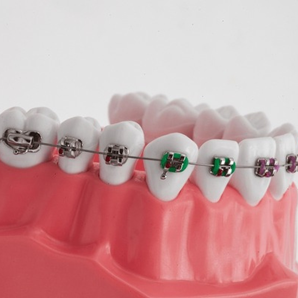 تقويم الأسنان المعدنى